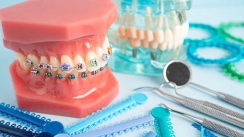 Orthodontie en de basisverzekering: hoe zit het écht?